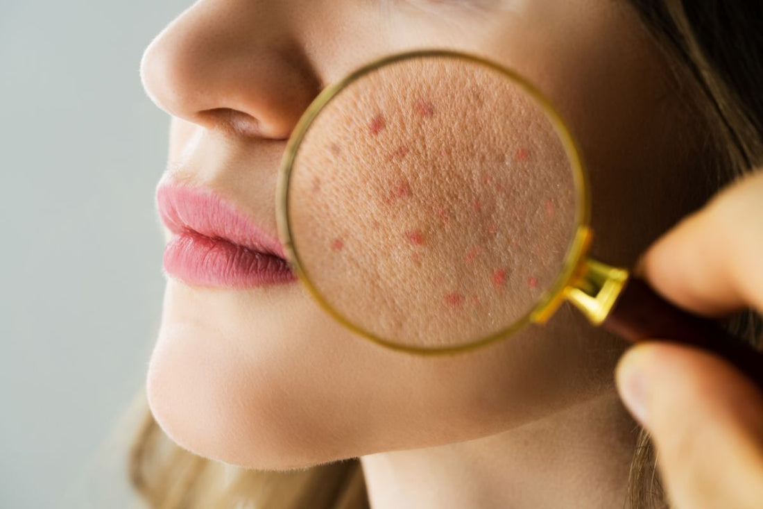 Does SPF Cause Breakouts? Here’s What’s Actually Happening